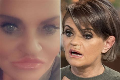 danniella westbrook face collapse.